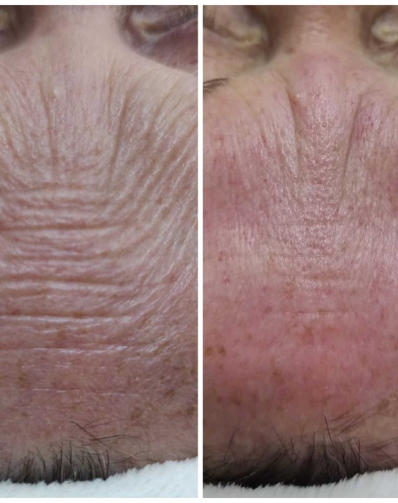 estetica-facial-testa-rugas-piracicaba