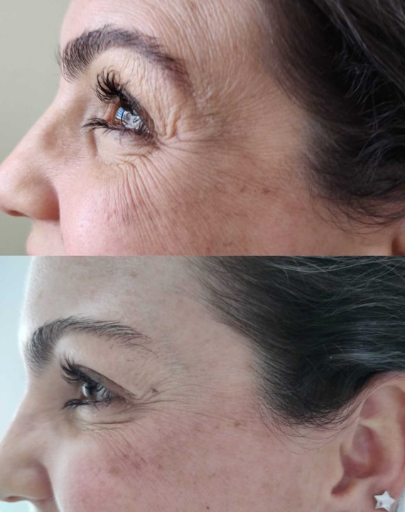 rugas-olhos-pes-galinha-estetica